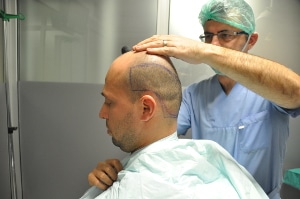 Préparation greffe de cheveux