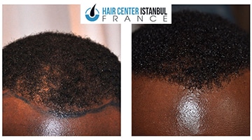 Avant Après greffe de cheveux afro