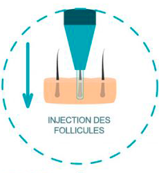 Injection des nouveaux greffons